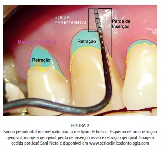 Mandíbula e Maxila c/ Fossa Articular, Implantes, Próteses e Procotolo com  4 Implantes