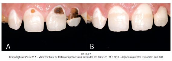 Impacto - Cor e Forma Interna de Dentes Anteriores (Edição