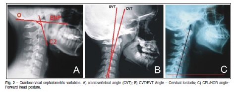 Craniocervical posture: cephalometric and biophotogrammetric analysis