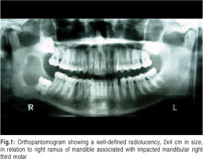 calcifying odontogenic cyst radiographic