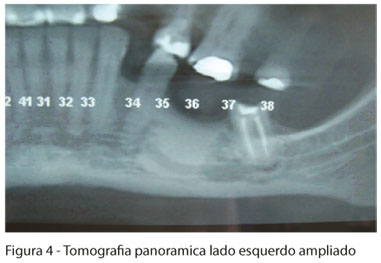 Osteoma de mandíbula: relato de caso