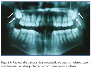 Homem Mandíbula Ou Maxilar Osso Com Dentes Em Três Quartos De