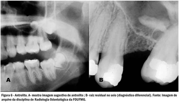 Radiografia Panorâmica da mandíbula não evidencia lesões sugestivas de