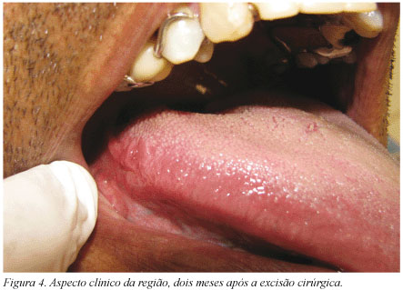 Cisto Linfoepitelial Oral - Patologia Bucal