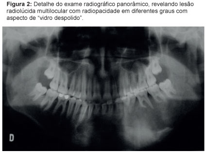 Osso ​ mandíbula (aspecto lateral).