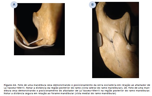 Osteomielites do complexo Maxilo Mandibular – Papaiz Diagnósticos