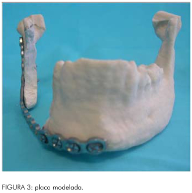 Prototipagem em 3D facilita o planejamento pr�-operat�rio em