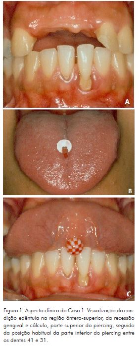 Considerações sobre o uso de piercing em lábios e língua