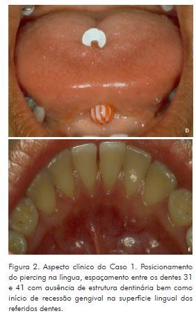 Considerações sobre o uso de piercing em lábios e língua