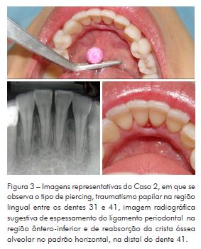 Piercing Oral na Adolescência