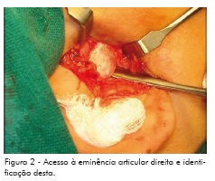 Tratamento/cirurgia da ATM