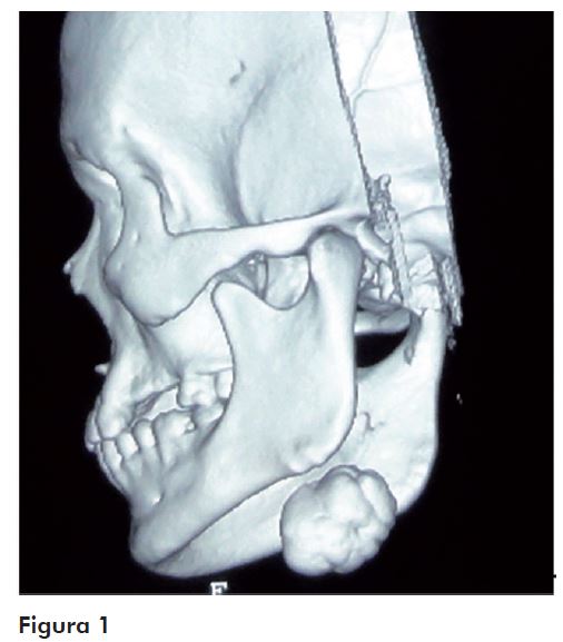 Osso ​ mandíbula (aspecto lateral).