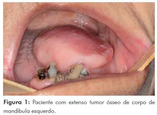 Osteoma de mandíbula: relato de caso