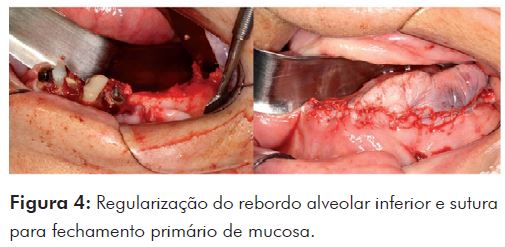 Osteoma de mandíbula: relato de caso