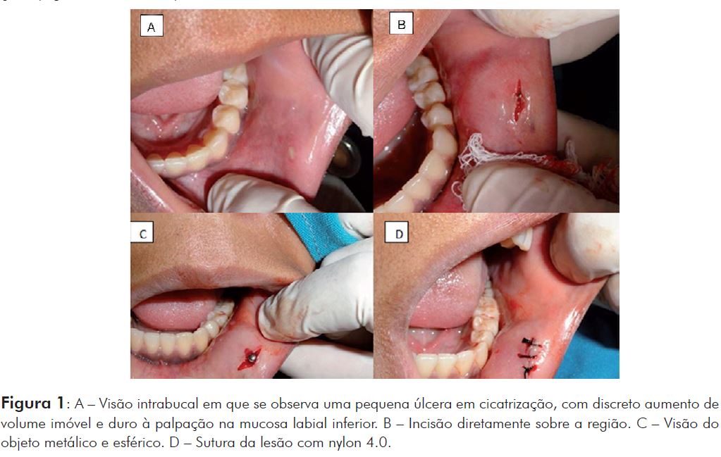 Quais os tipos de piercing na boca mais danosos à saúde bucal?