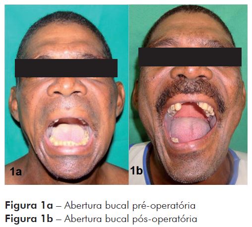 TRATAMENTO PARA Fratura Mandibular