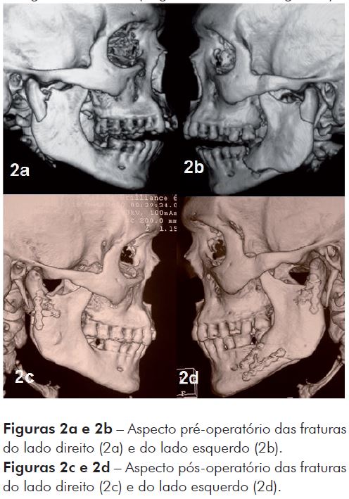 TRATAMENTO PARA Fratura Mandibular