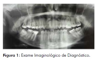 Radiografia Panorâmica de Mandíbu-la. Pós-Operatório de cinco meses.