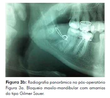 acidente maxilar e mandibula