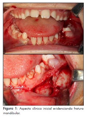 TRATAMENTO PARA Fratura Mandibular