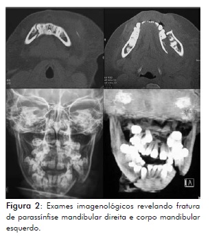 TRATAMENTO PARA Fratura Mandibular