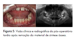 TRATAMENTO PARA Fratura Mandibular