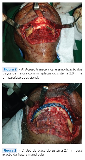 TRATAMENTO PARA Fratura Mandibular