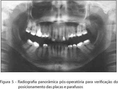 Radiografia Panorâmica de Mandíbu-la. Pós-Operatório de cinco meses.