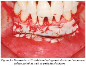 vestibuloplasty grafting grafts vestibule mandible mandibular palatal mucosa