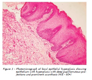 Papillomatous epidermal hyperplasia icd 10. Icd 10 for papillomatosis