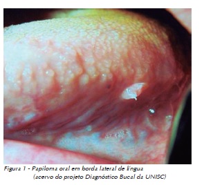 Papiloma na lingua