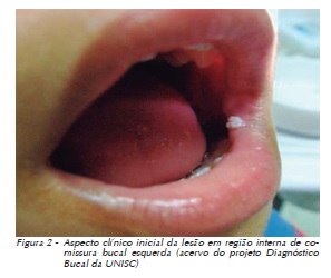 papiloma de celulas escamosas na boca