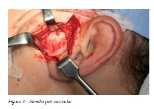 Tratamento/cirurgia da ATM