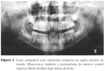 Radiografia Panorâmica da mandíbula não evidencia lesões sugestivas de