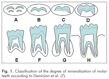 Calcification On Teeth