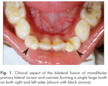 fusion teeth