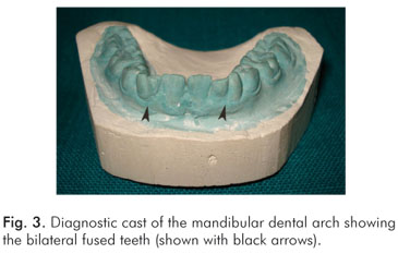 fusion teeth