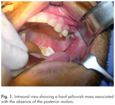 Maxillary deals sinus infection