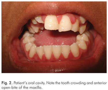 apert syndrome teeth