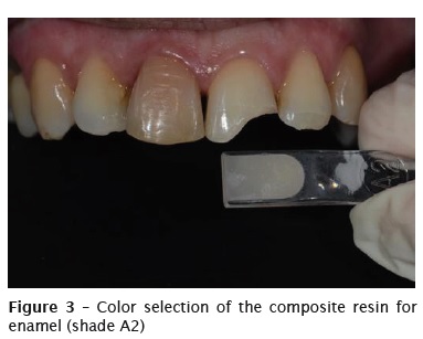3Color Dental Light-Curable Resin Light-Curing Composite Resin