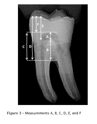 Anatomical Analysis Of The Pulp Chamber Of Artificial Teeth