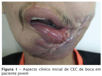 cancer bucal caso clinico