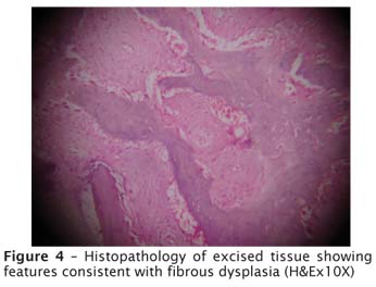 polyostotic fibrous dysplasia histology