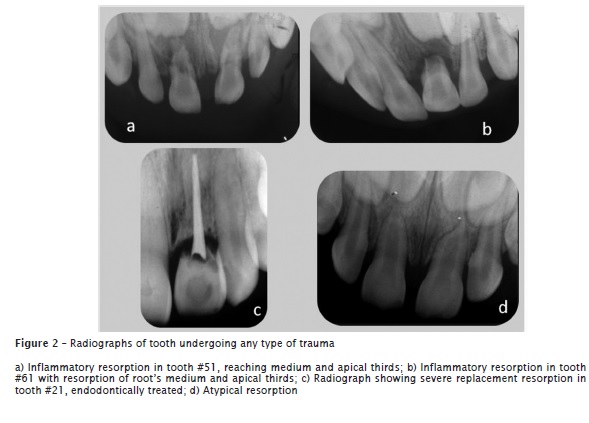 external resorption of tooth