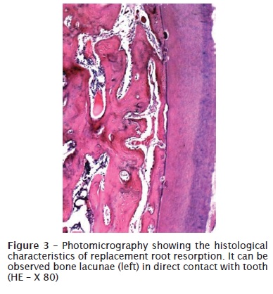 Root resorption in orthodontics literature review