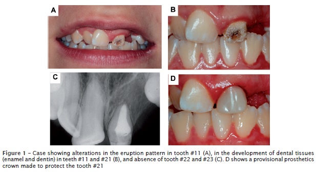 prevalence dental trauma deciduous teeth brazilian children