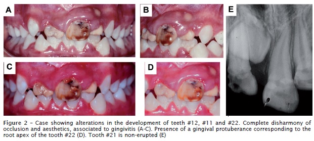 prevalence dental trauma deciduous teeth brazilian children