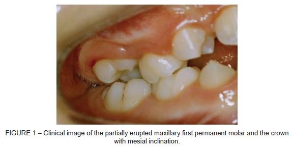 permanent teeth early eruption