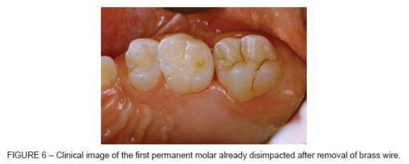 what teeth are permanent molars