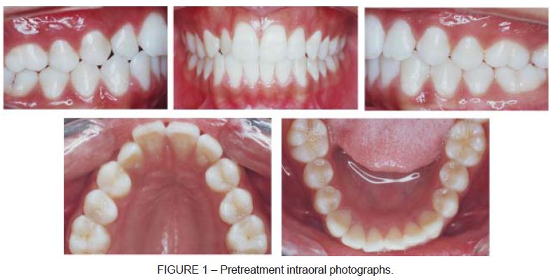Root resorption in orthodontics literature review